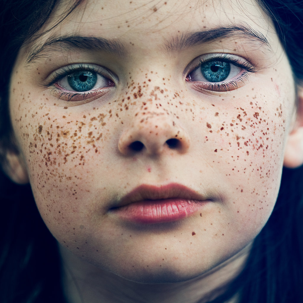 freckles-before